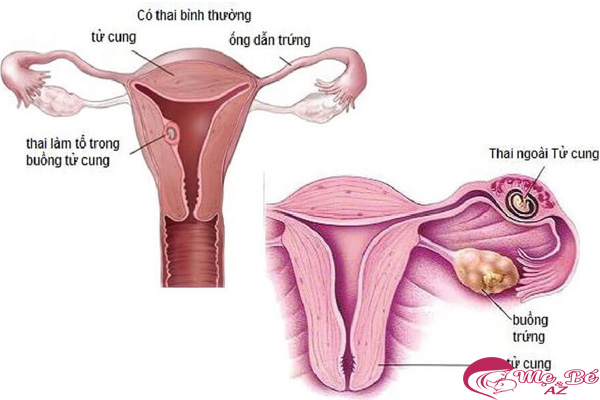 Đau bụng đến ngất xỉu: Biểu hiện có thai ngoài tử cung