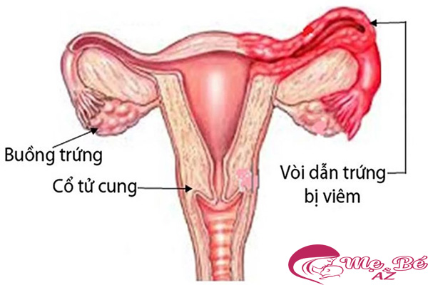 Đau bụng đến ngất xỉu: Biểu hiện có thai ngoài tử cung