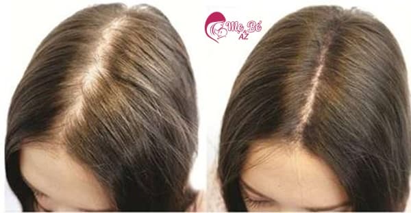 sau khi sinh bao lâu thì rụng tóc
