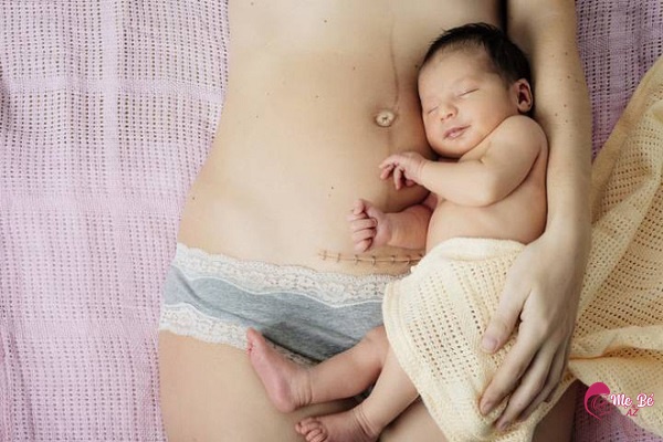 Sinh mổ bao lâu mới sinh lại được là câu hỏi rất nhiều mẹ quan tâm