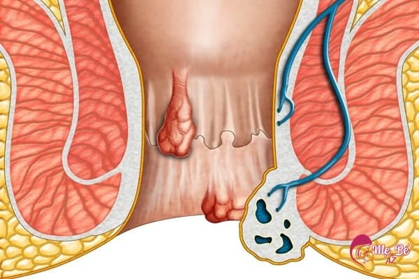Biểu hiện bệnh trĩ sau khi sinh