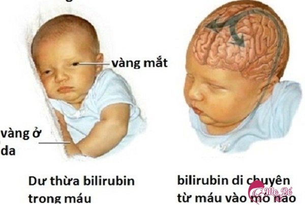 Vàng da bệnh lý ở trẻ sơ sinh rất nguy hiểm