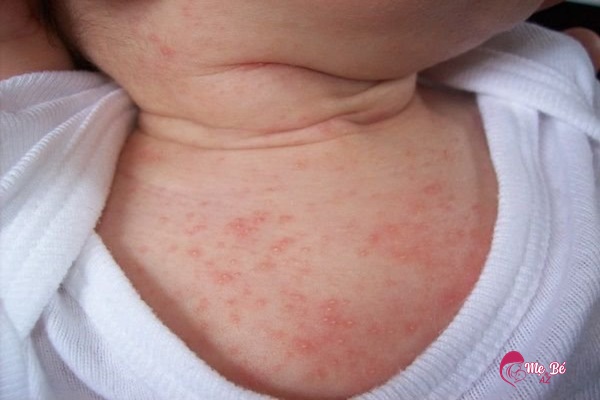 Những vấn đề bệnh lý ở trẻ sơ sinh thường gặp