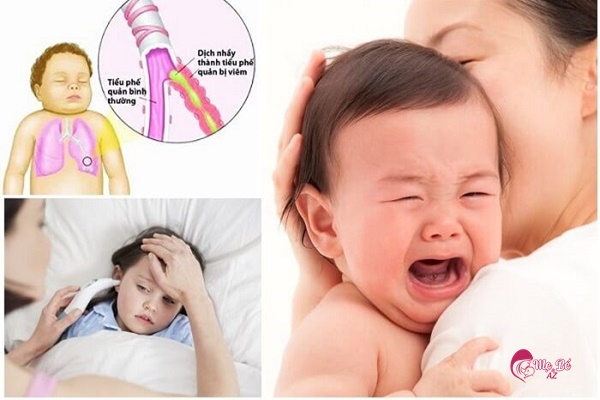 Viêm phế quản là bệnh thường gặp ở trẻ sơ sinh