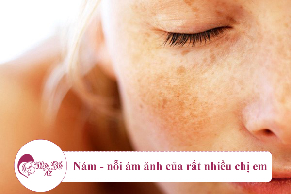 Nám - nỗi ám ảnh của rất nhiều chị em